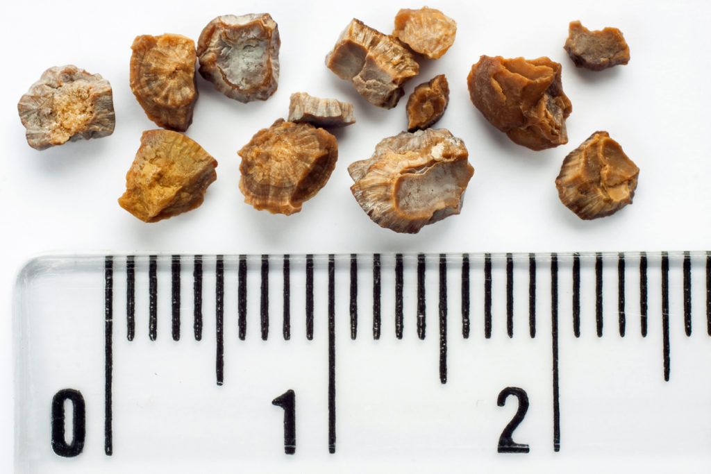 Debunking 3 Common Kidney Stone Myths-Urology Specialists of Georgia